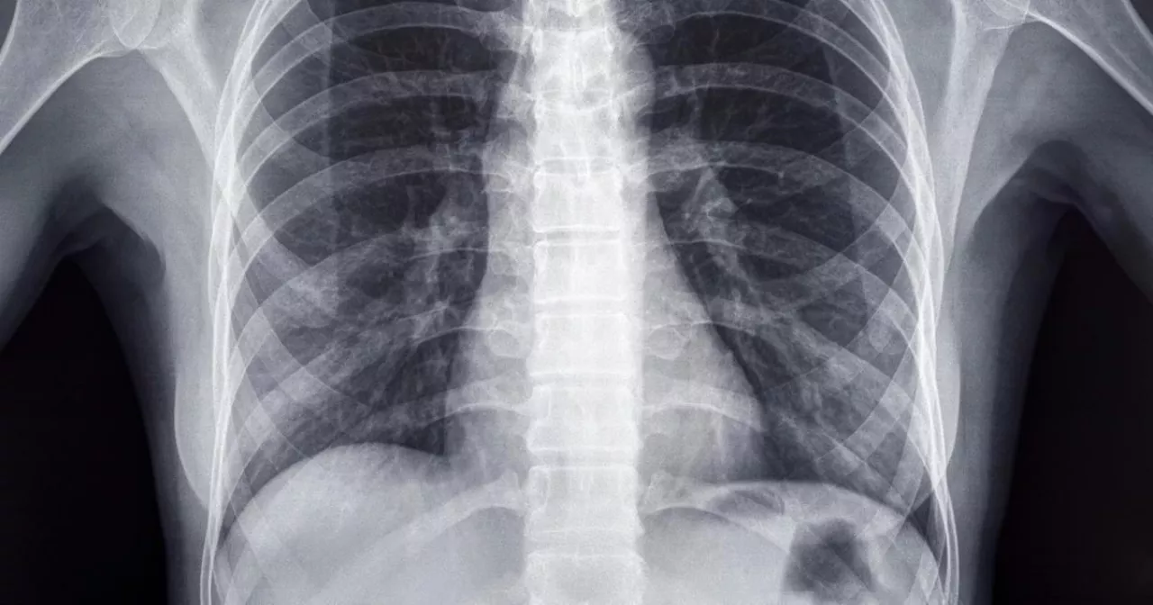 rak pluća rak pluća